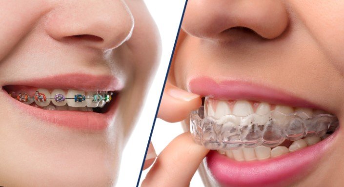 Invisalign vs Smile Direct Club